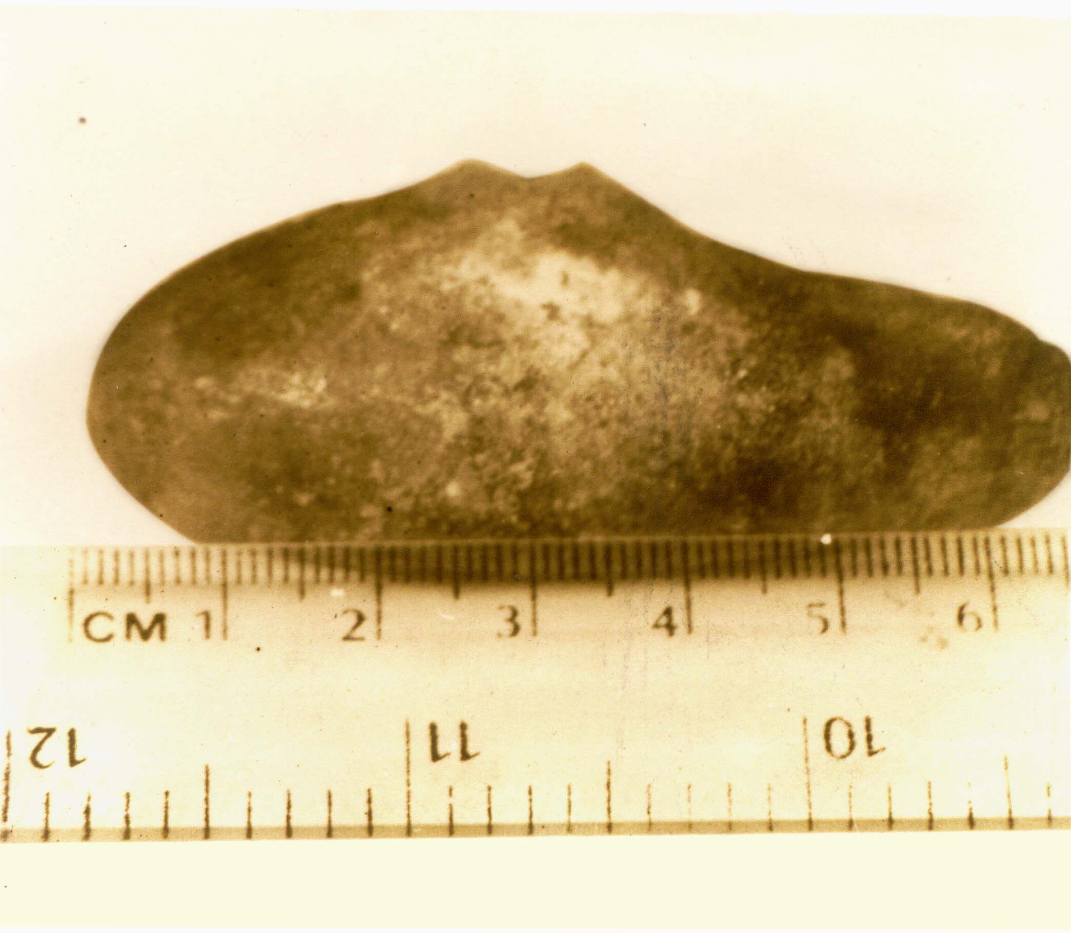 Identify The Unusual Gallstone